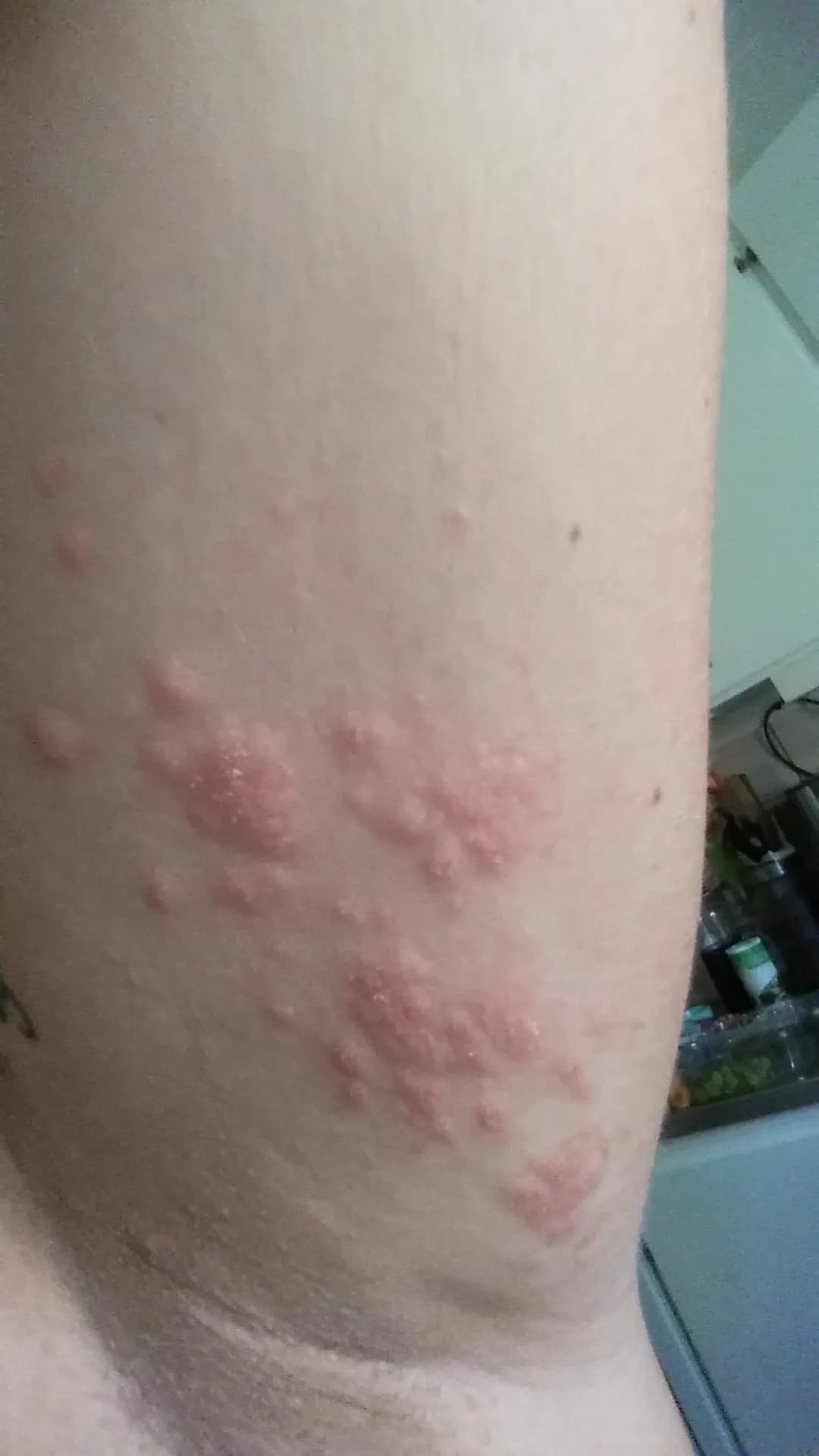 kliande prickar under armen  (varning äcklig bild)